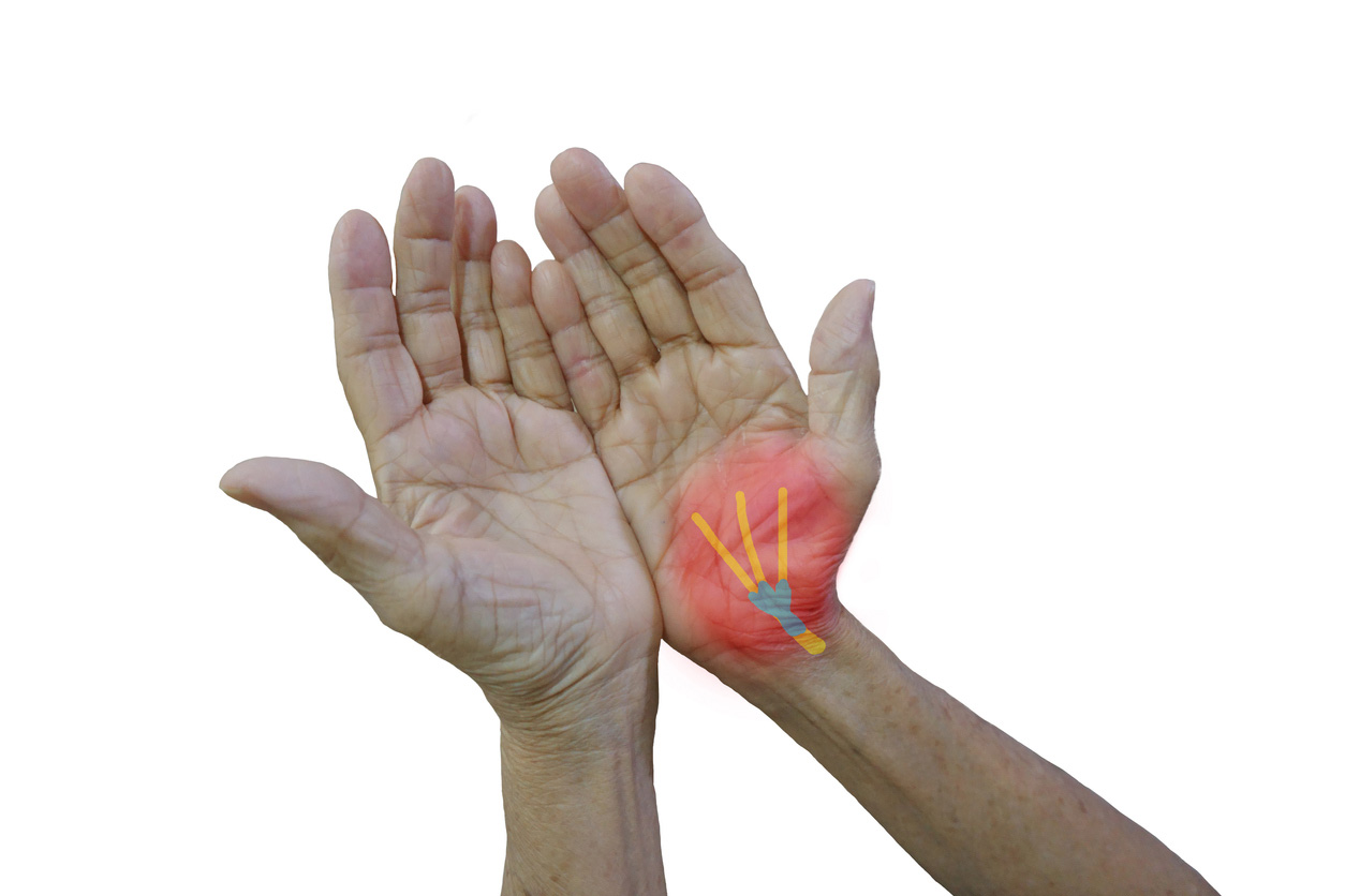 median nerve radiofrequency